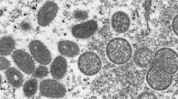 Vaiolo delle scimmie, Ecdc avverte: molto probabili casi importati in Ue di Mpox