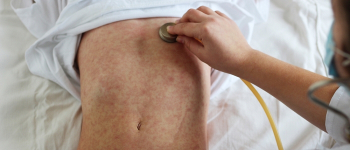 Morbillo, 1.045 casi in Italia nel 2024: il 90% non era vaccinato
