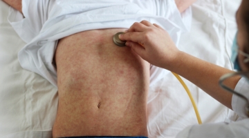 Morbillo, 1.045 casi in Italia nel 2024: il 90% non era vaccinato