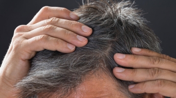 Generazione di stempiati, l'assalto dei giovani ai tricologi: "Ma i social distorcono la realt&agrave;"