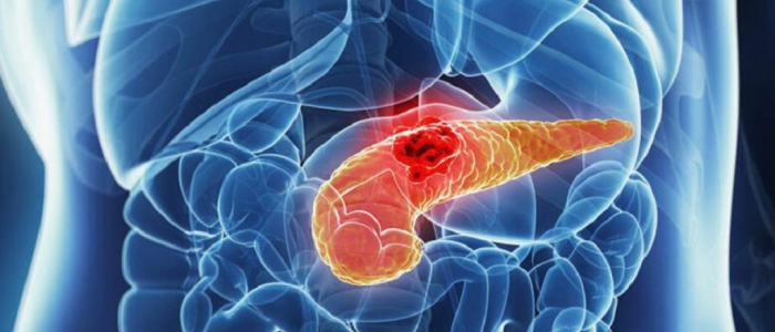 Tumore al pancreas, primo s&igrave; in Ue per il farmaco che raddoppia la sopravvivenza