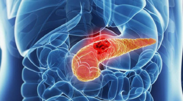 Tumore al pancreas, primo s&igrave; in Ue per il farmaco che raddoppia la sopravvivenza